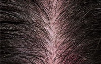 Empfindliche Kopfhaut