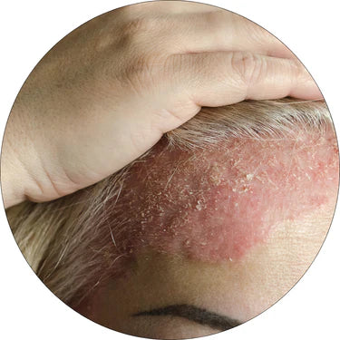 Starke Kopfhautprobleme