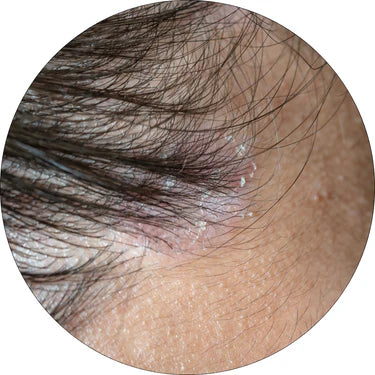 Leichte Kopfhautreizung