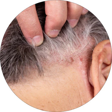 Mittlere Kopfhautprobleme